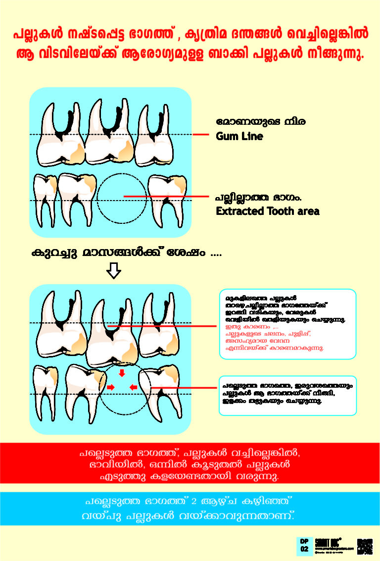 how-missing-teeth-causes-mobility-of-other-teeth-malayalam-dp-02-m