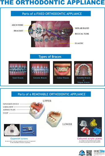 Types of Braces (Fixed Appliances)