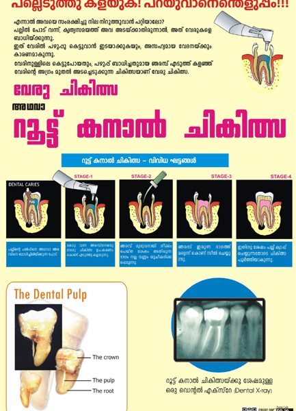 Root Canal Treatment Malayalam Dp M Smart Doc Posters