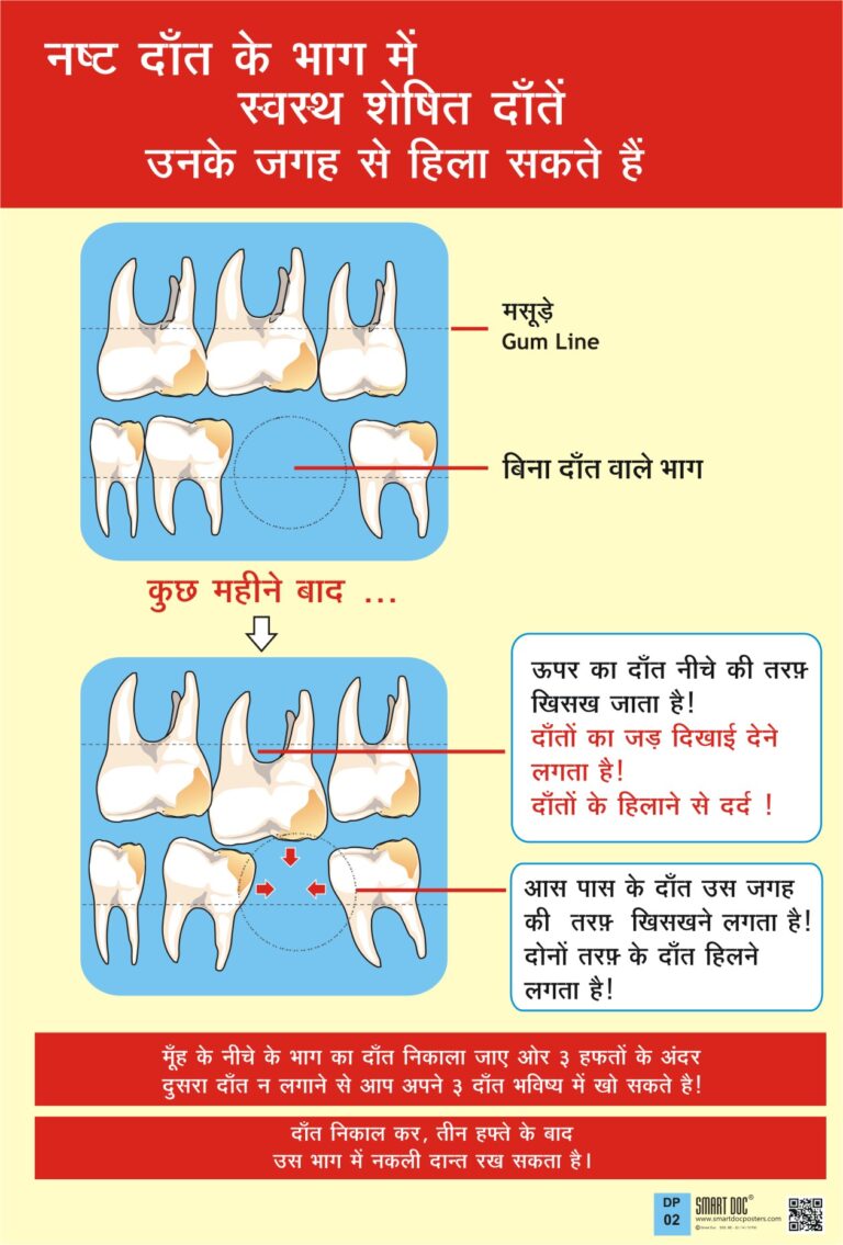 How missing teeth causes mobility of other teeth (Hindi) DP02H