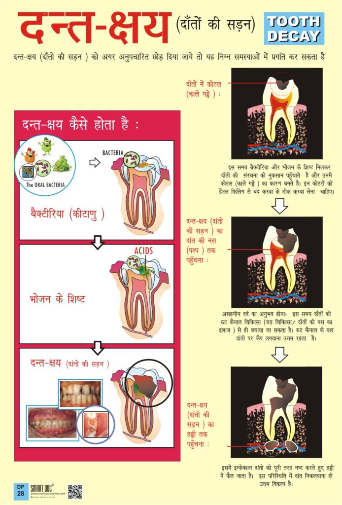Dental caries Formation and progression if left untreated (Hindi) DP