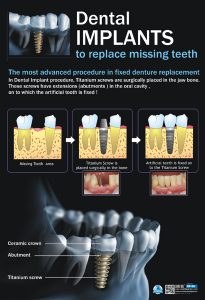 Dental Implants (eng.) Dp-06 