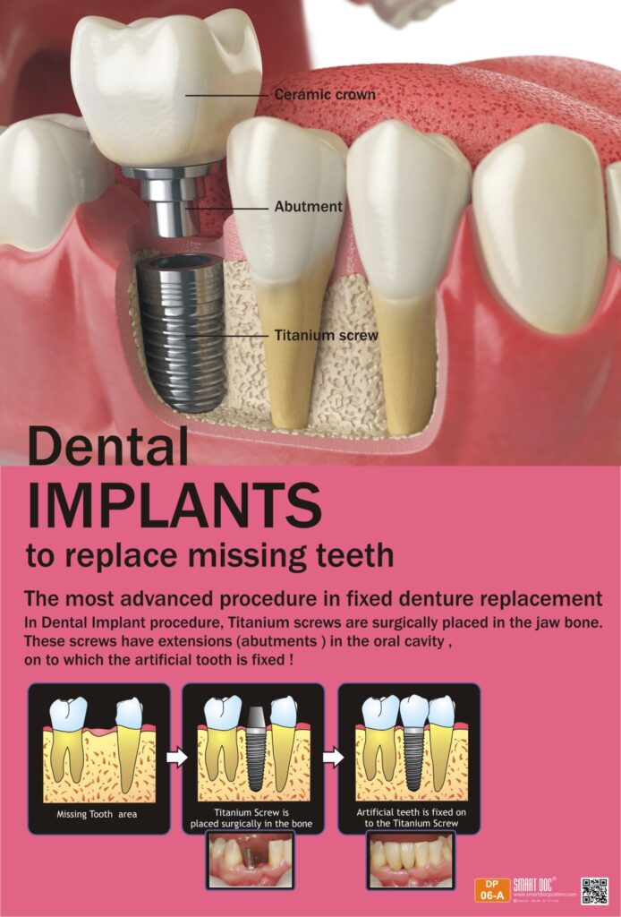 DP06 ( A) E Dental Implants Smart Doc Posters