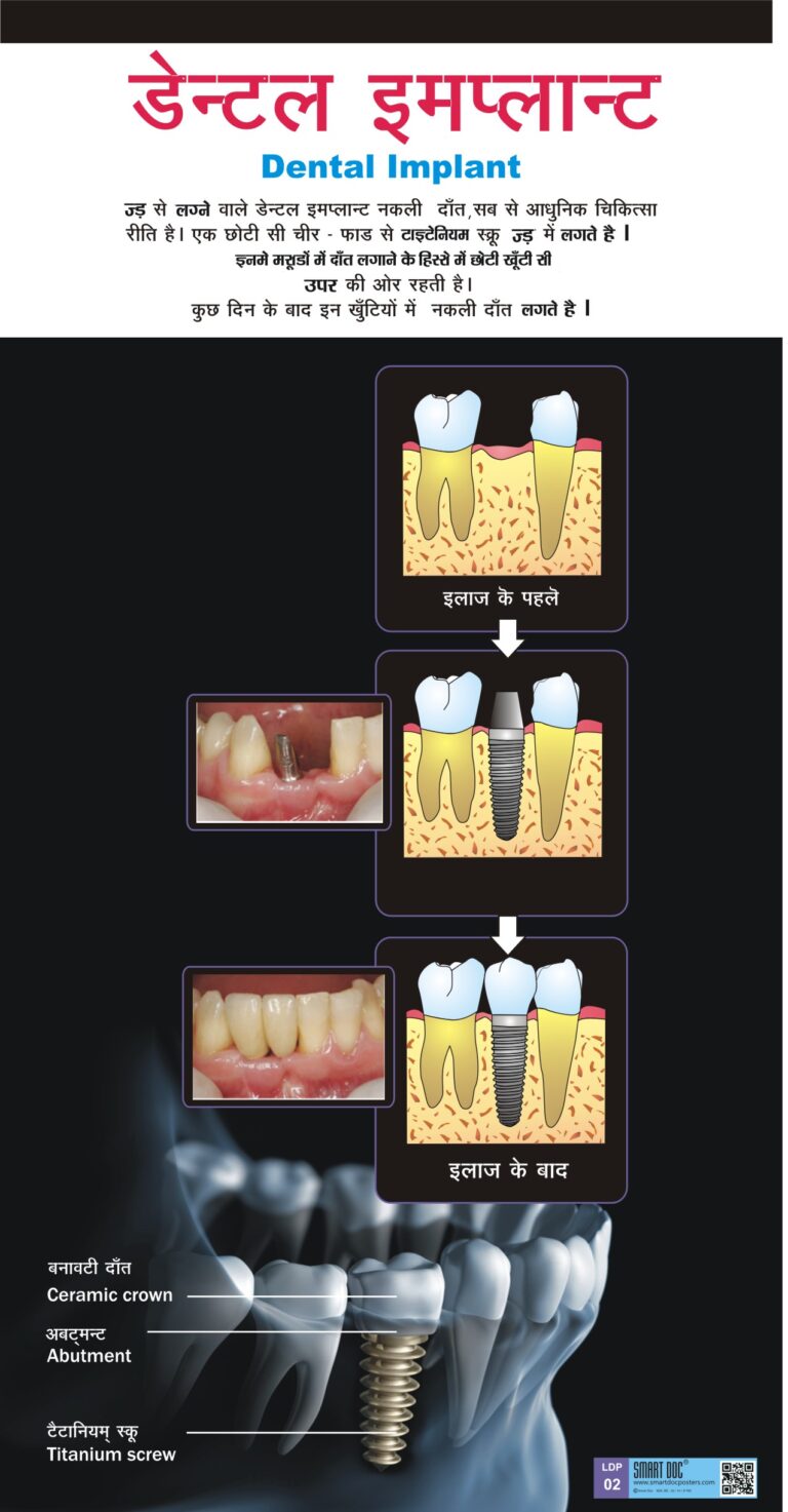 LDP02 ( H) Dental implants Smart Doc Posters