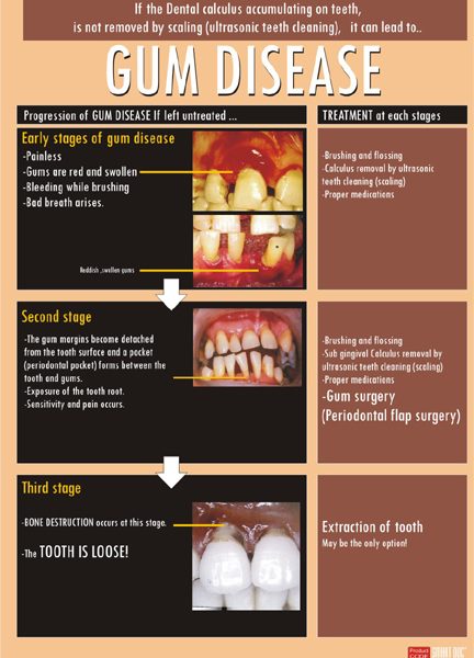 Gum disease-progression if left untreated (Eng.) DP-39 E. – Smart Doc ...